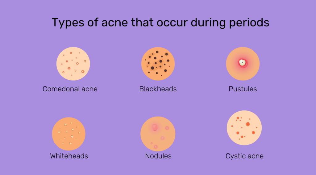 Pimples During Periods: Enjoy Clear Skin During Periods