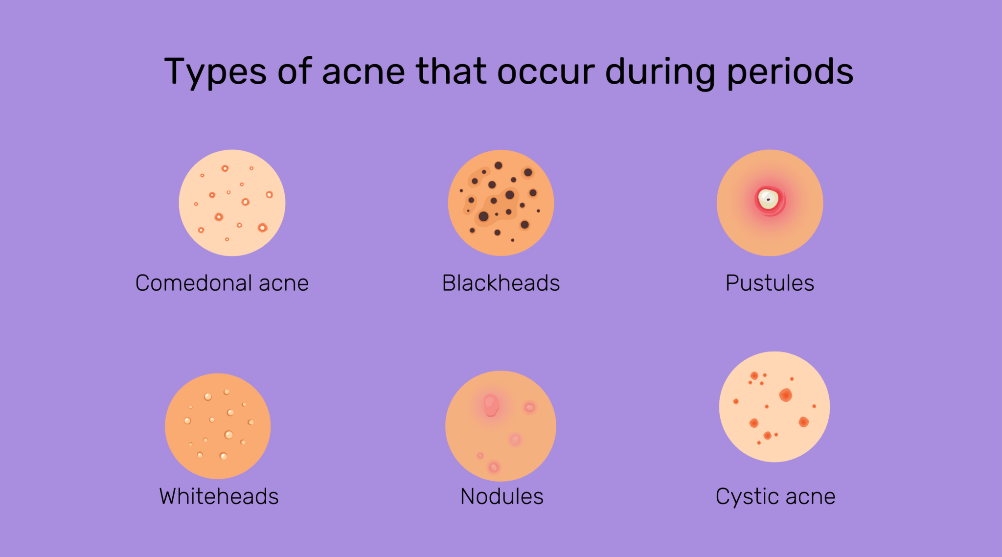 Pimples During Periods: Enjoy Clear Skin During Periods